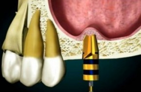 Dantų implantacijos mitai